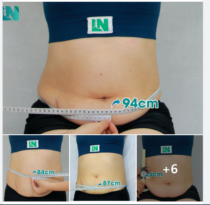 HÚT MỠ TẠO DÁNG THẨM_MỸ KẾT HỢP  CẤY MỠ NGỰC, CẢI THIỆN DÁNG VÓC CHO BÀ MẸ 2 CON KHÔNG CĂNG DA