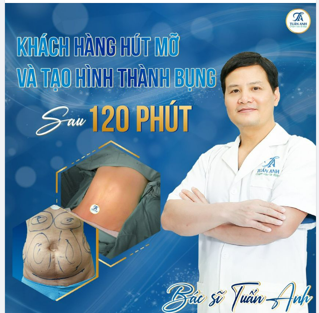 Hút mỡ và tạo hình thành bụng là combo được ƯU CHUỘNG NHẤT mùa hè này tại Thẩm Mỹ Tuấn Anh - ĐÁNH BAY BÉ MỠ, ĐÓN HÈ RỰC RỠ