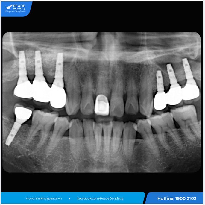 IMPLANT ĐÚNG LÀ CHÂN ÁI 
