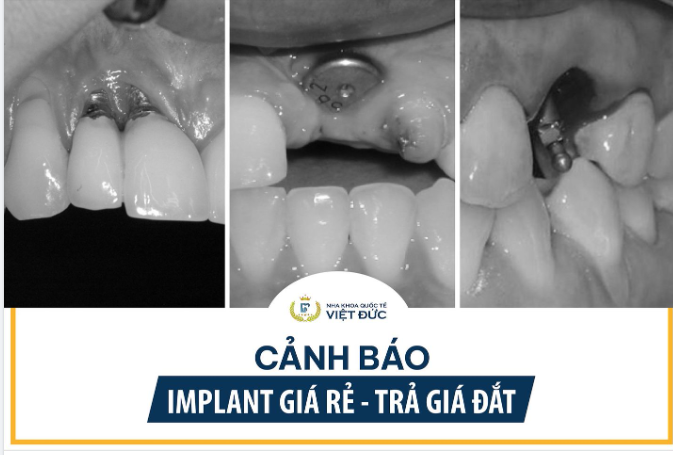 IMPLANT GIÁ RẺ - TRẢ GIÁ ĐẮT