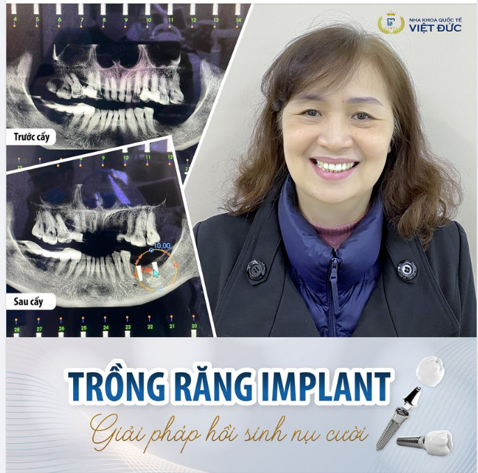 IMPLANT - GIẢI PHÁP HỒI SINH NỤ CƯỜI