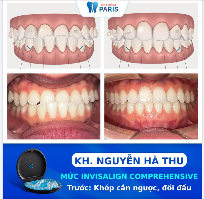 INVISALIGN - DỊCH CHUYỂN RĂNG THEO CÁCH CỦA BẠN