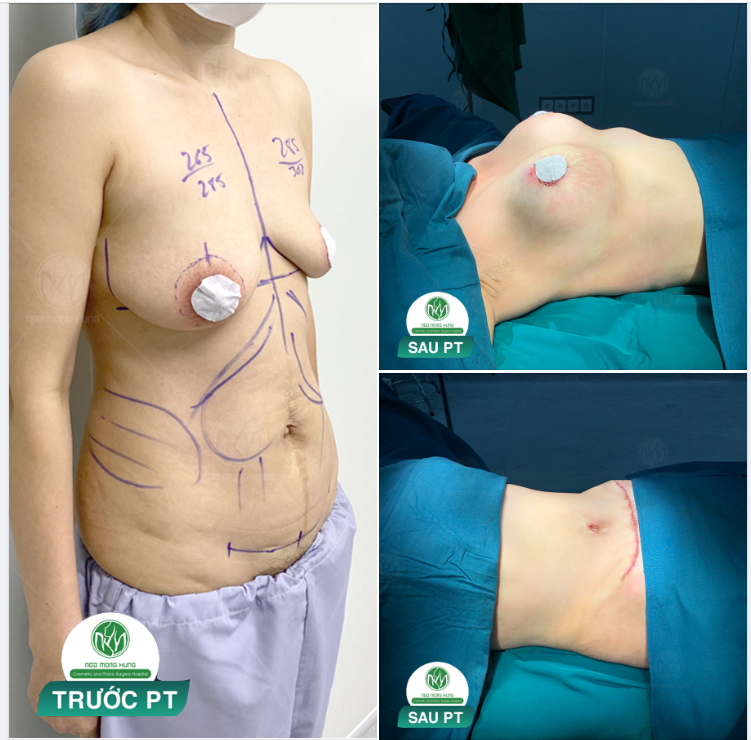KẾT QUẢ CA THẨM MỸ VÓC DÁNG CỦA CHỊ KHÁCH