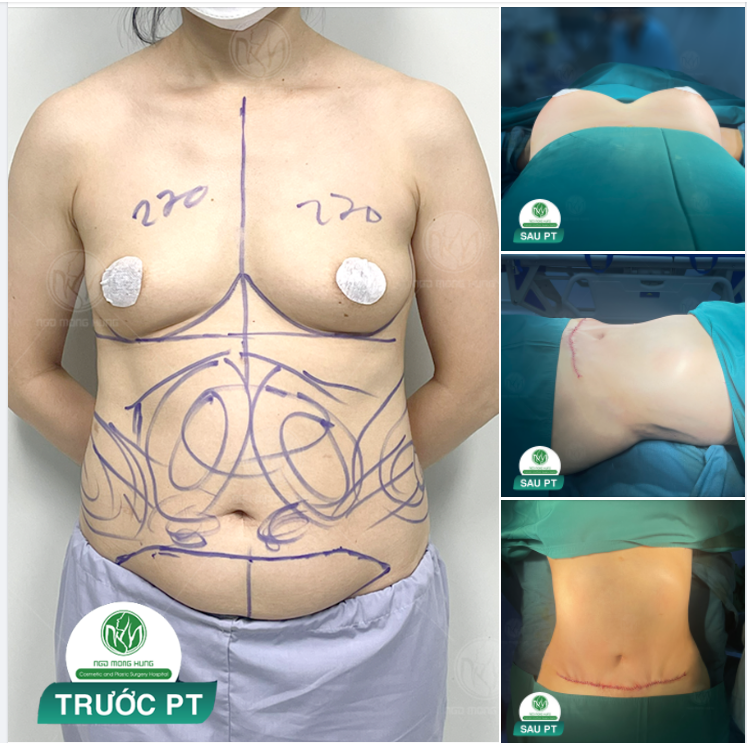 KẾT QUẢ MÀ NHIỀU CHỊ EM CHỜ ĐỢI ĐÂY !!