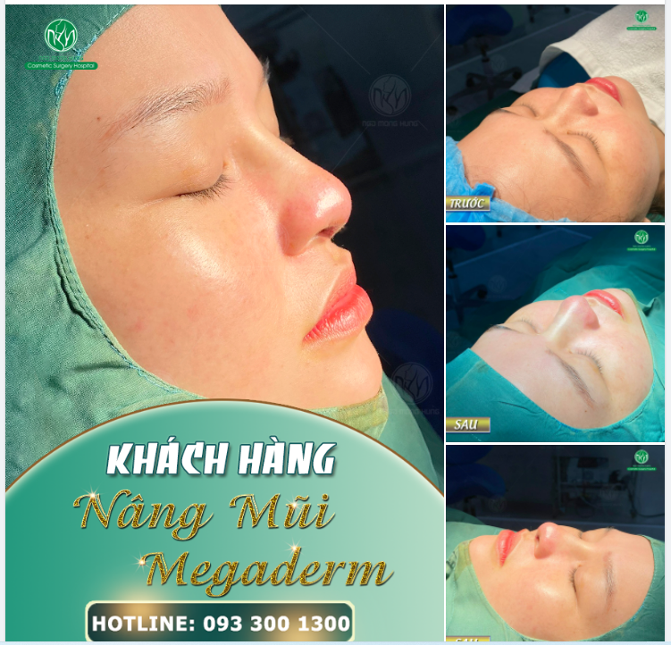 KẾT QUẢ NÂNG MŨI MEGADERM CHO KH CÓ DÁNG MŨI THẤP