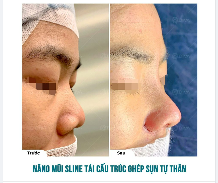 KẾT QUẢ NÂNG MŨI SLINE TÁI CẤU TRÚC GHÉP SỤN TỰ THÂN