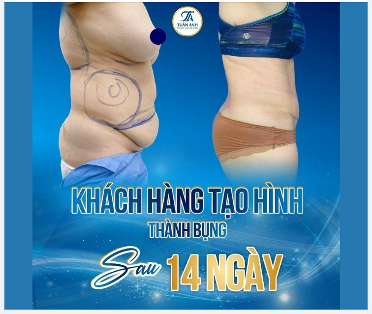 KẾT QUẢ SAU 14 NGÀY THỰC HIỆN PP TẠO HÌNH THÀNH BỤNG TẠI THẨM MỸ TUẤN ANH !