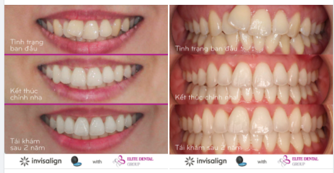 KẾT QUẢ SAU 2 NĂM THÁO NIỀNG RĂNG TẠI ELITE NHƯ THẾ NÀO?