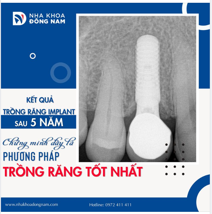KẾT QUẢ TRỒNG RĂNG IMPLANT SAU 5 NĂM