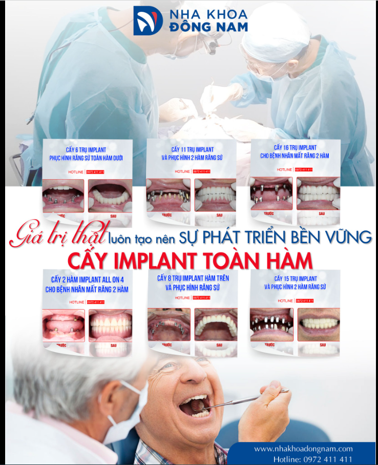 KẾT QUẢ TRỒNG RĂNG IMPLANT TOÀN HÀM THÀNH CÔNG