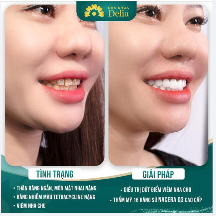 KH Minh Huệ trước khi đến Delia