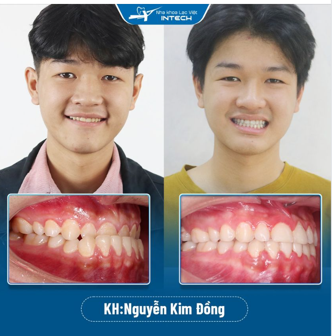 KHẮC PHỤC HOÀN TOÀN RĂNG MÓM NHỜ NIỀNG RĂNG CÔNG NGHỆ X-MATRIX