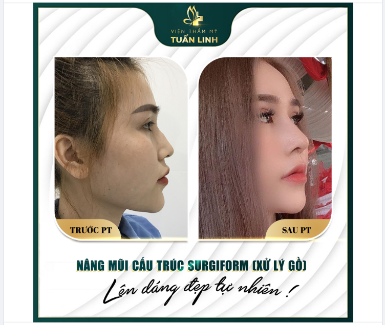 KHẮC PHỤC HOÀN TOÀN TÌNH TRẠNG SỐNG MŨI GỒ ''KÉM SANG''