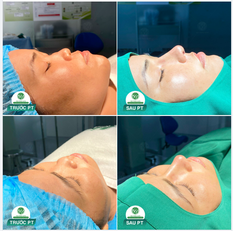 KHẮC PHỤC MỌI KHUYẾT ĐIỂM VỚI DÁNG MŨI S LINE