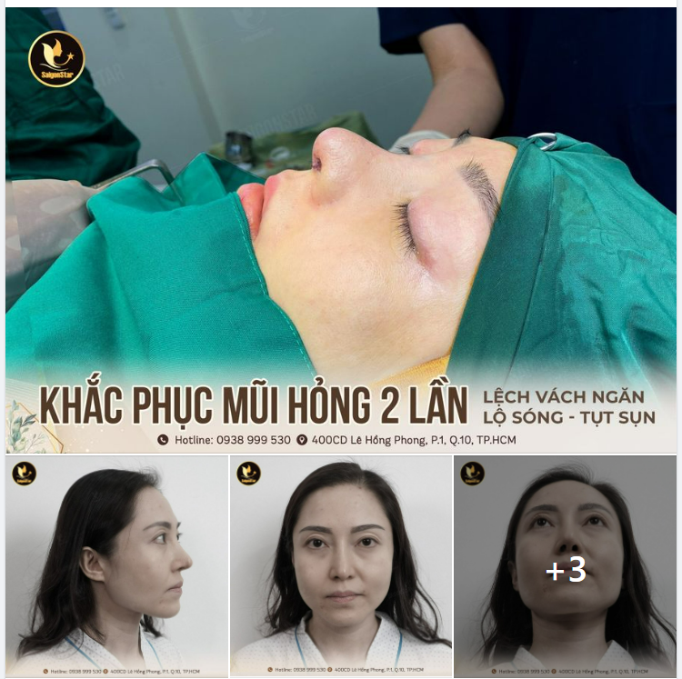 KHẮC PHỤC MŨI HỎNG 2 LẦN