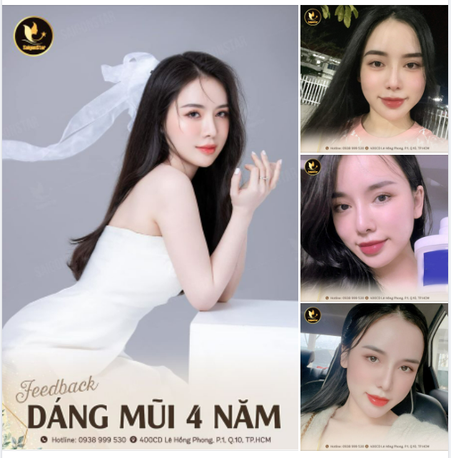 Khách hàng nâng mũi cấu trúc tại Dr Hoạt sau 4 năm đẹp xuất sắc