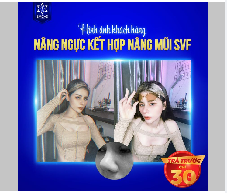 KHÁCH HÀNG NÂNG NGỰC KẾT HỢP NÂNG MŨI SVF