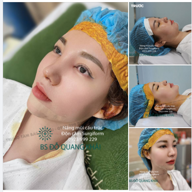 KHÁCH HÀNG THỰC HIỆN NÂNG MŨI SURGIFORM 4 NGÀY VÀ QUAY LẠI Bs Đỗ Quang Khải để thực hiện ĐỘN CẰM SURGIFORM - XỬ LÝ FILLLER CẰM