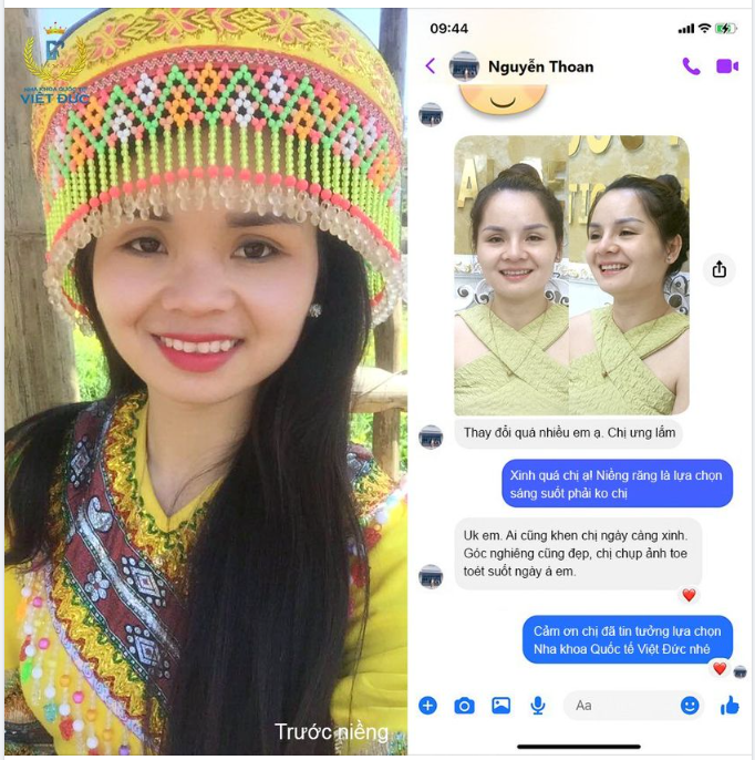 KHÁCH HÀNG XINH ĐẸP SAU KHI NIỀNG RĂNG