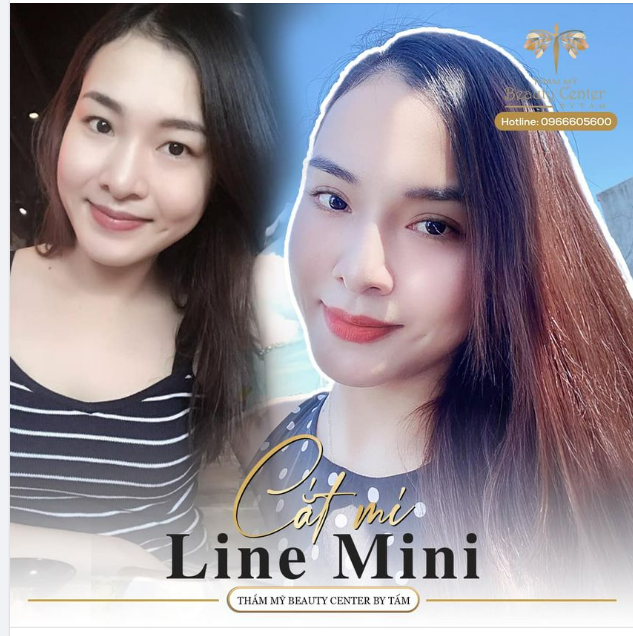 KHÁCH HÀNG “XINH ĐẸP TUYỆT VỜI” KHI CẮT MÍ KHÔNG SẸO LINE MINI TẠI TMV TẤM