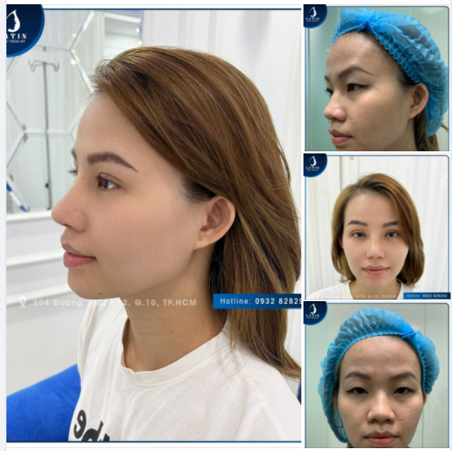 Khách làm combo mũi bán cấu trúc, thu nền xương, bọc lót Megaderm và cắt mí 4D