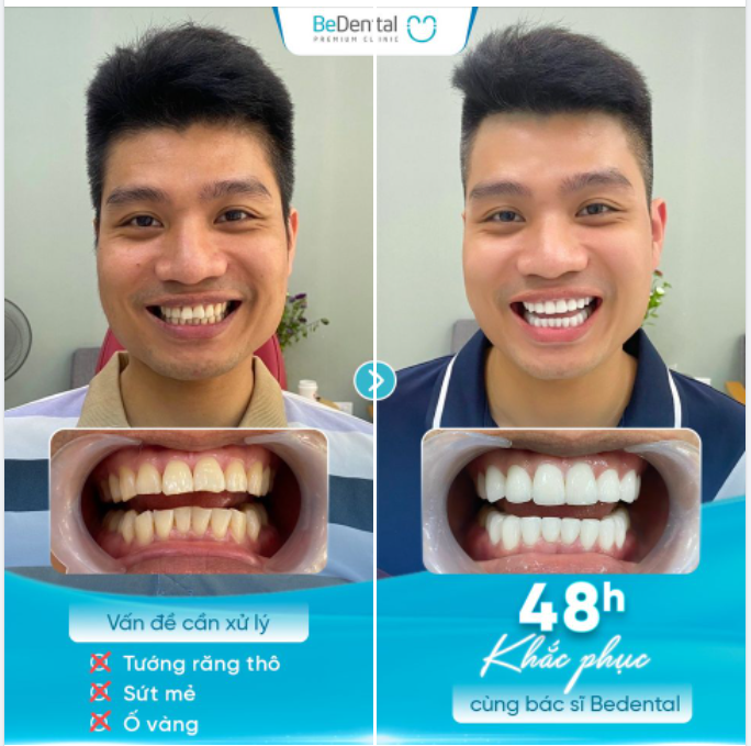 Khách Lưu Hoài Nam thẩm mỹ 20 răng sứ Roland HD