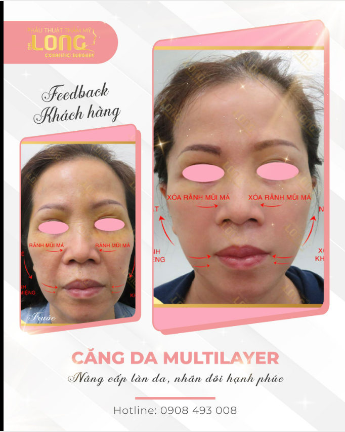 KHÁM PHÁ SỰ TRẺ HÓA KỲ DIỆU ĐẾN TỪ PHƯƠNG PHÁP CĂNG DA MULTILAYER