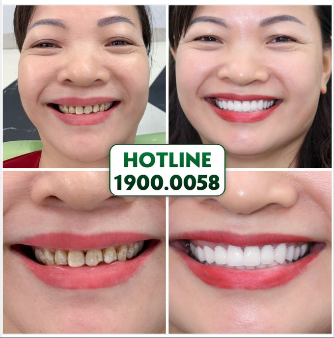 KHI BẠN CÒN CHẦN CHỪ, NGƯỜI KHÁC ĐÃ ĐẸP HẾT RỒI!!!