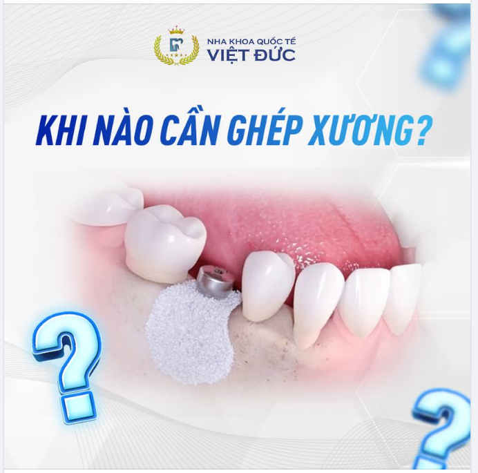 KHI NÀO CẦN CẤY GHÉP XƯƠNG TRONG TRỒNG RĂNG IMPLANT