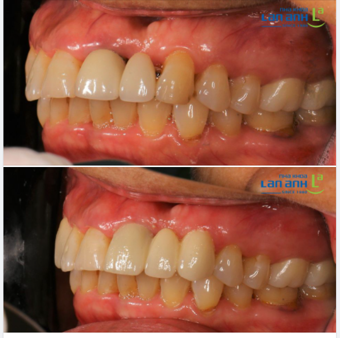 Khi răng sứ đã làm quá lâu, nó có thể bị cũ, đổi màu, nướu bị tụt, không còn chính xác, thẩm mỹ bị ảnh hưởng.