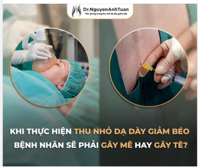 Khi thực hiện Thu nhỏ Dạ dày giảm béo bệnh nhân sẽ phải GÂY MÊ hay GÂY TÊ