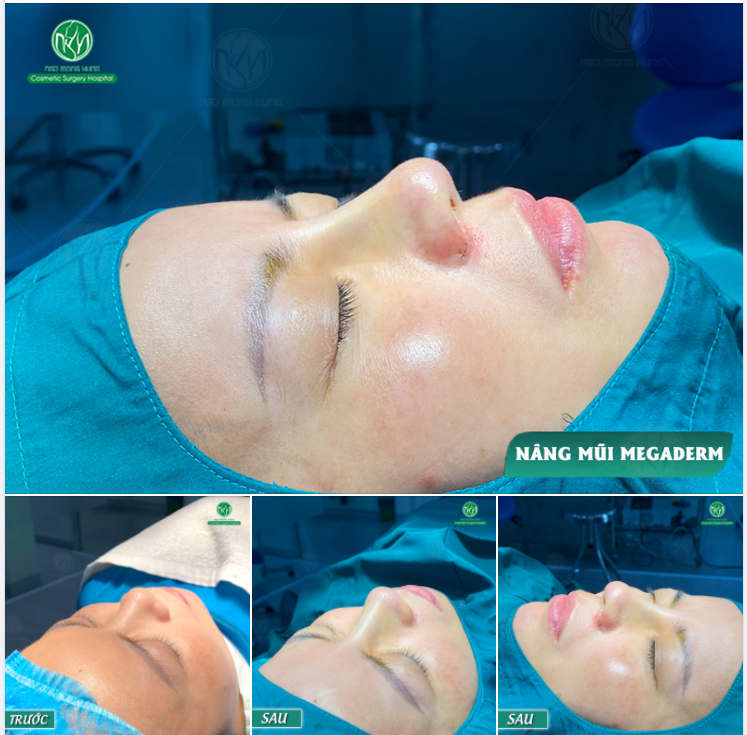 KHOE CẬN CẢNH DÁNG MŨI ĐẸP MỌI GÓC NHÌN