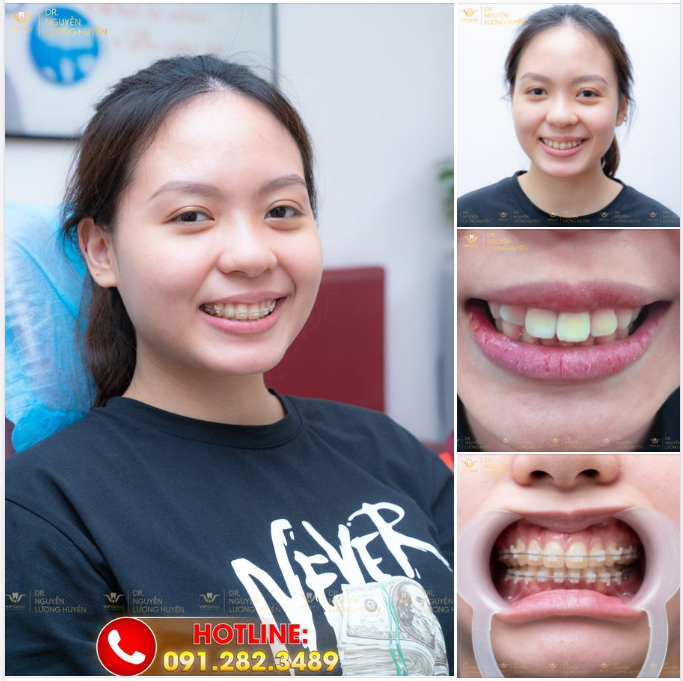 KHOE NỤ CƯỜI DUYÊN - CHỜ ĐÓN NGÀY THÁO NIỀNG GẦN KỀ
