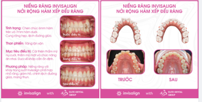 Không có hàm răng xấu, chỉ có hàm răng chưa được Elite Dental chỉnh với Invisalign