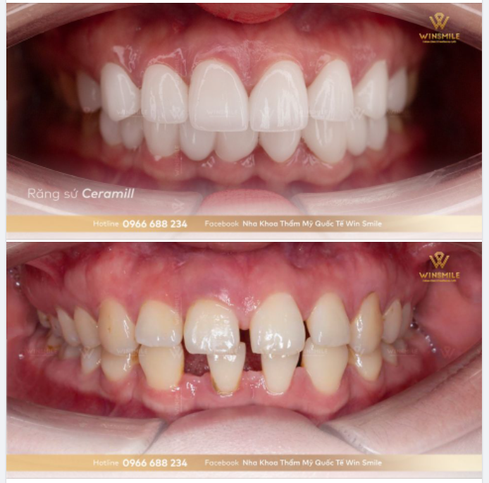 KHÔNG CÒN KHOẢNG TRỐNG, BỪNG SÁNG TỰ TIN VỚI RĂNG SỨ CERAMILL