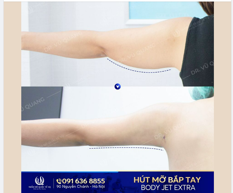 Không dám mặc áo hai dây vì có bắp tay thô