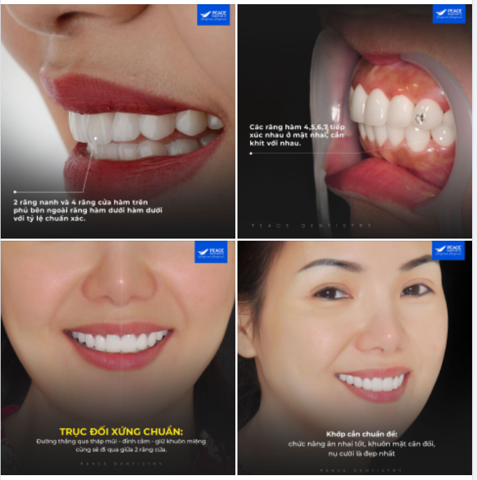 KHỚP CẮN CHUẨN TRONG THẨM MỸ RĂNG SỨ