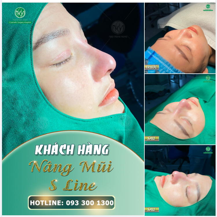 KHUÔN MẶT NỔI BẬT HƠN NHỜ DÁNG MŨI S LINE