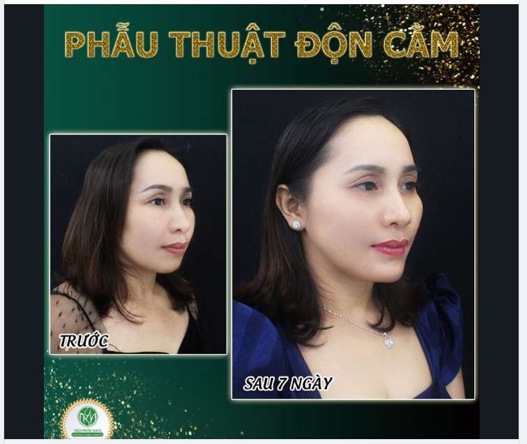 KHUÔN MẶT THANH TÚ SAU ĐỘN CẰM V LINE