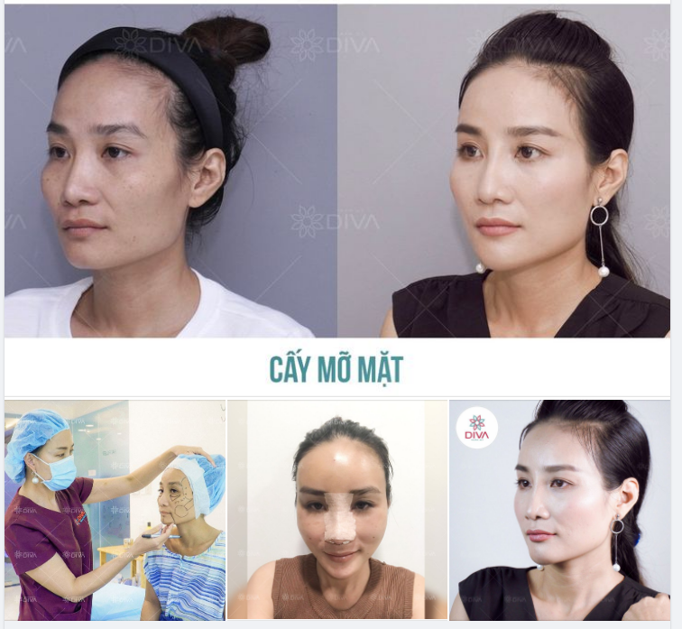 KQ THẨM MỸ CẤY MỠ COLEMAN, NÂNG MŨI MẶT ĐẸP TINH TẾ, HÀI HÒA