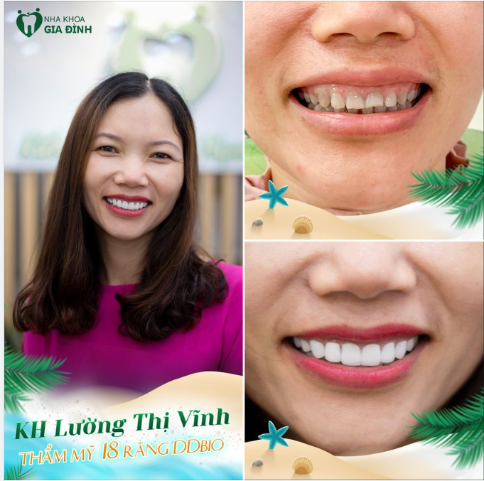 LÀM RĂNG ĐẸP NGAY CHỈ SAU 2 NGÀY