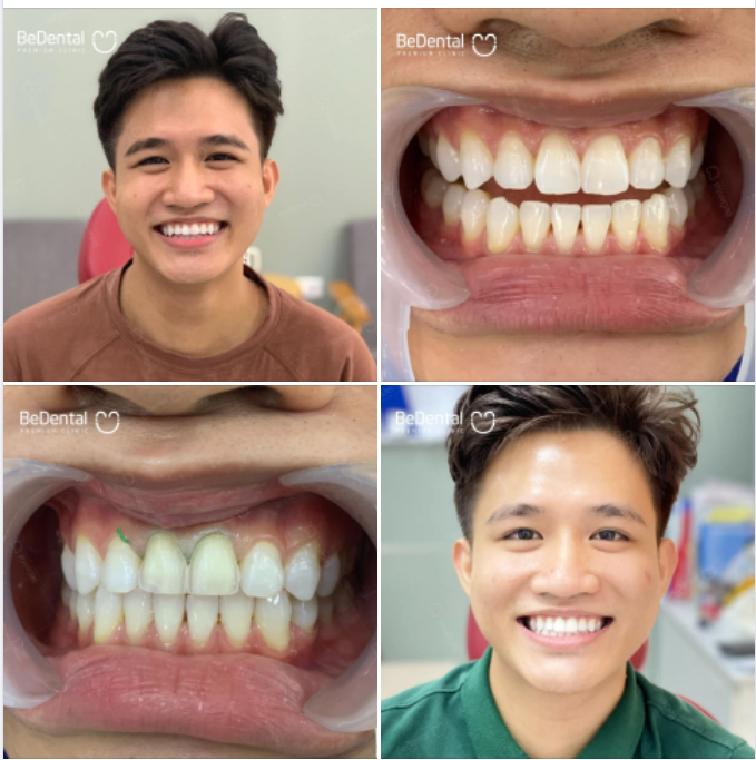   LÀM RĂNG TẠI BEDENTAL CAM KẾT KHÔNG MÀI NHỎ