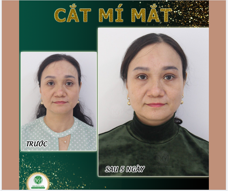 LẤY LẠI ĐÔI MẮT TRẺ TRUNG NHƯ THỜI THANH XUÂN
