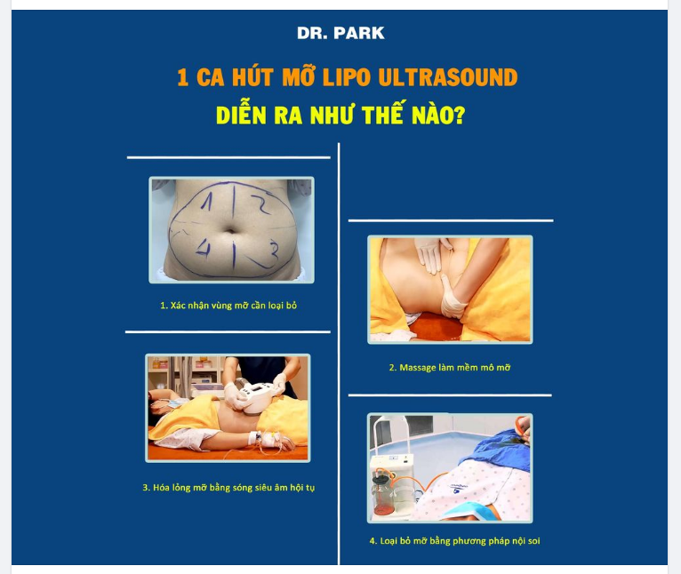 LIPO MỠ NỘI SOI ĐƯỢC TIẾN HÀNH NHƯ THẾ NÀO
