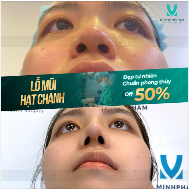 Lỗ mũi to, mất cân xứng theo nhân tướng học sẽ không tốt cho vận mệnh, khiến tiền tài hao hụt không phanh, sự nghiệp ảnh hưởng.