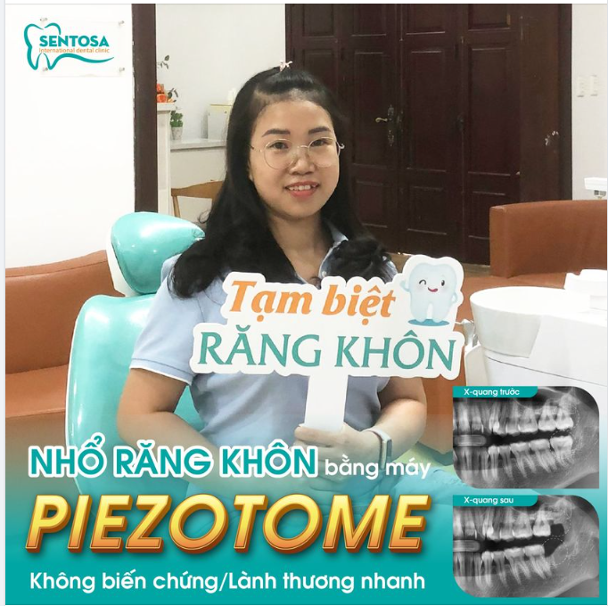 LOẠI BỎ RĂNG KHÔN - ĂN NGON CHẲNG LO ĐAU NHỨC