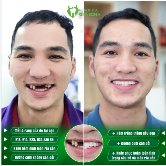 LỢI ÍCH RÕ RÀNG NHẤT SAU KHI LÀM RĂNG SỨ CHÍNH LÀ THAY ĐỔI NGOẠI HÌNH
