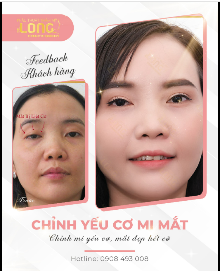 LÝ DO VÌ SAO ĐÔI MẮT CỦA BẠN LUÔN TRONG TÌNH TRẠNG “LỜ ĐỜ” THIẾU SỨC SỐNG