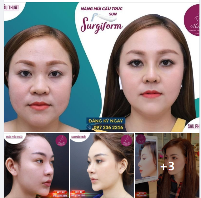 MẤT BAO NHIÊU ĐỂ SỬA 1 CHIẾC MŨI HỎNG