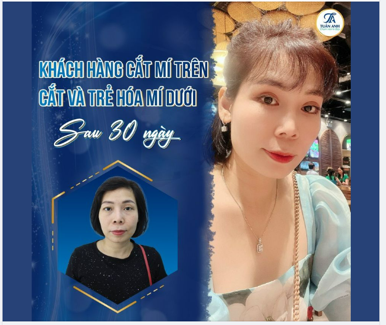 Mắt của em giờ đẹp lắm anh ạ, nhìn trẻ hẳn ra, ai cũng khen.
